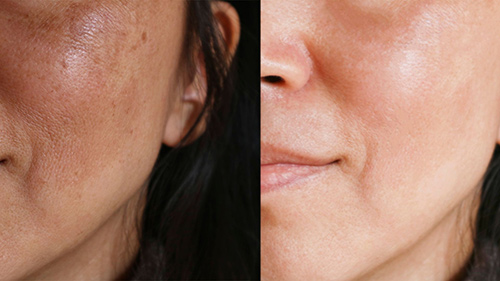 before and after hydrafacial treatment