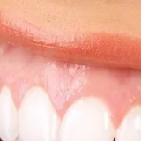 Spirir gingival